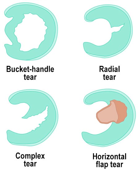Examples of meniscus tear types.