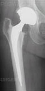 X-ray image showing total hip replacement