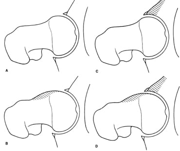 An illustration of different impingement types from an article about Femoroacetabular Impingement.
