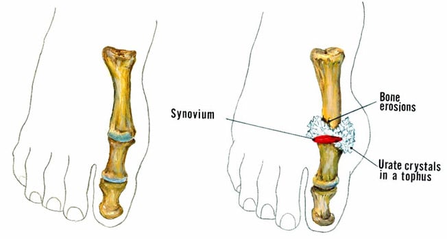 illustration of a normal toe and then one with a gouty tophus
