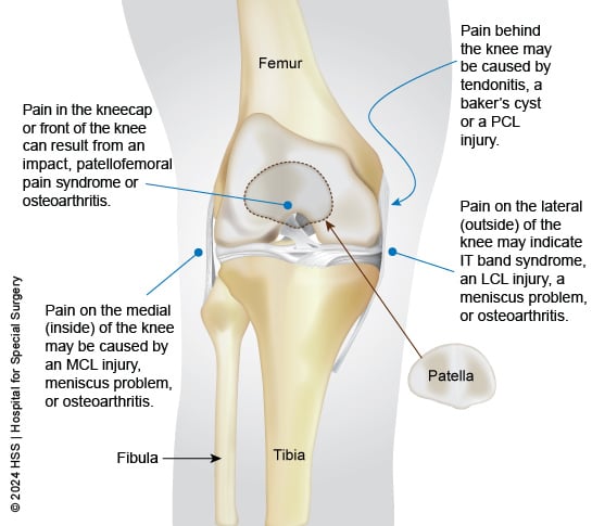 Chart showing knee pain by location on the knee.