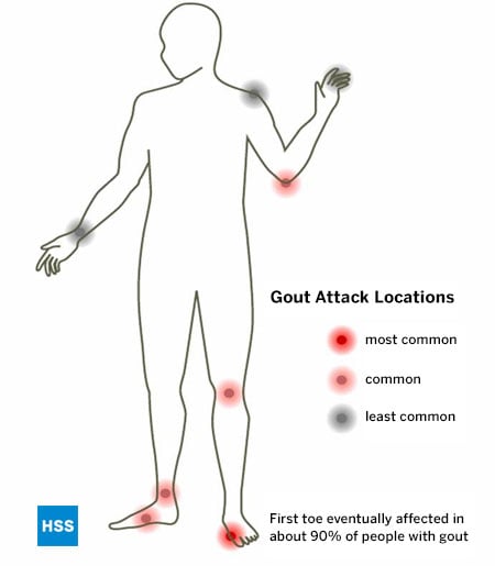 An illustration of the human body showing common locations for gout, with gout attack locations in the body labeled by commonality, with the big toe being most common, midfoot and knee joints common, and the wrist and shoulder joints least common, and note that the first (big) toe is eventually affected in about 90% of individuals with gout.