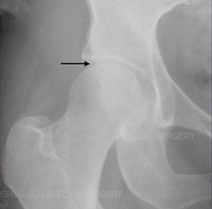 Anteroposterior radiograph of a normal hip joint