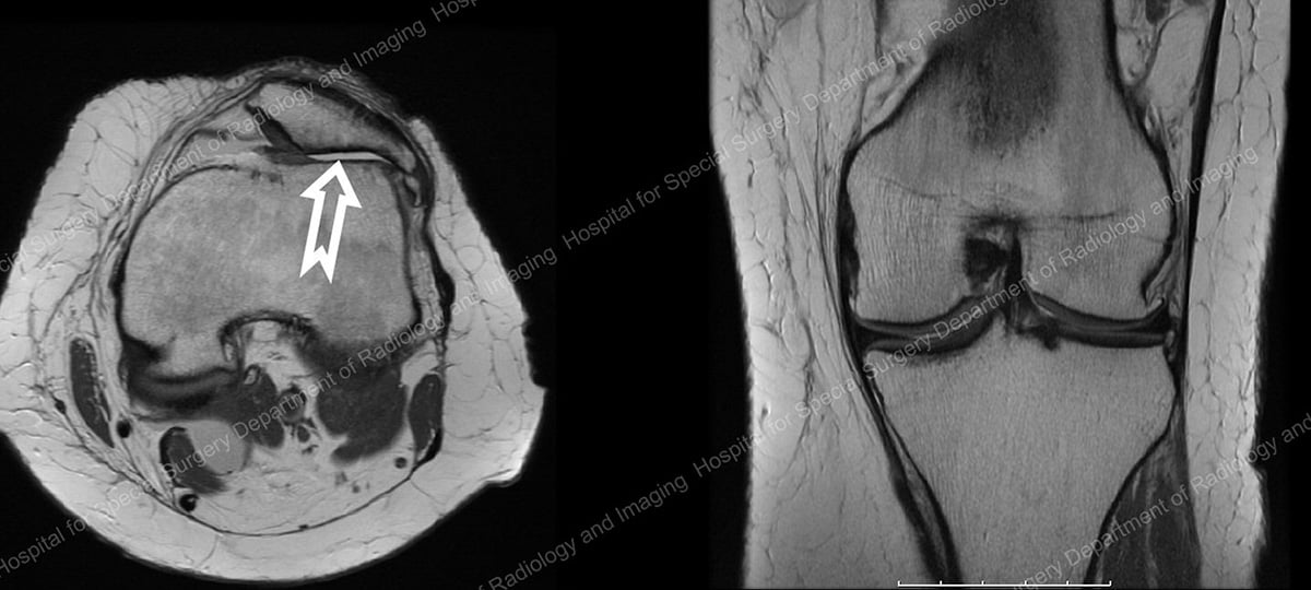 MRI images of a patient with severe arthritis in the patellofemoral compartment in the knee
