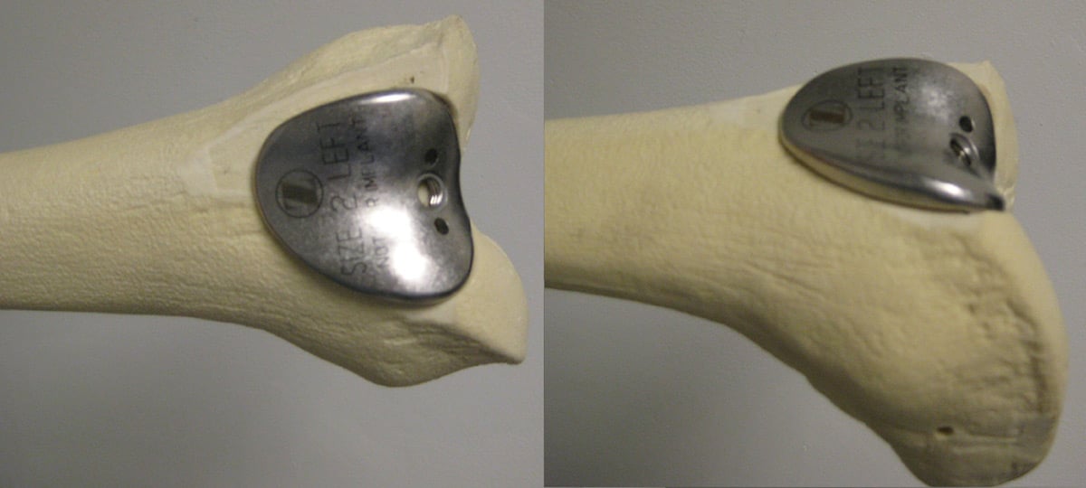 image of a patellofemoral knee replacement implant