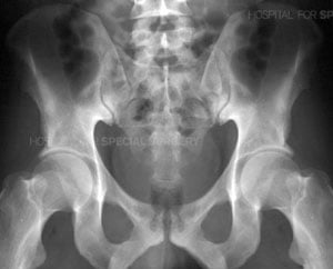 A radiograph of a normal pelvis from an article about Pelvic Fractures/Acetabular Fractures