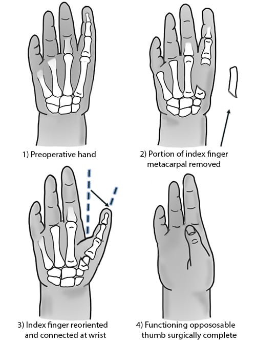 Illustration of the stages of pollicization.