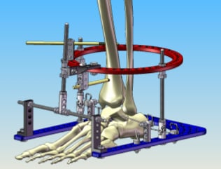 Image - RAD ankle distraction external fixator