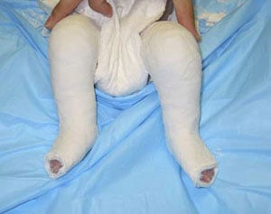 The second cast is applied with the outer edge of the foot still tilted downward.