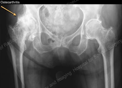 X-ray view of the hip joint showing severe joint space narrowing.