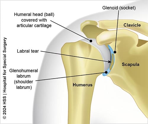 Illustration of the shoulder with a labral tear.