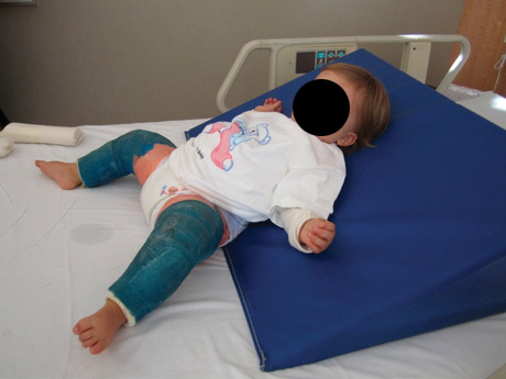 A child in a spica cast with wedge pillow supporting the back