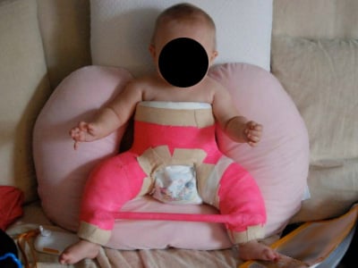 An infant wearing a spica cast to treat hip dysplasia.