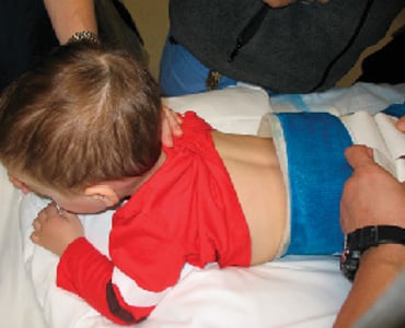 A child in a spica cast, belly down.