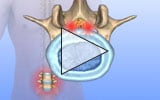 Lumbar Spinal Stenosis Animation with Narration - click to laucnch