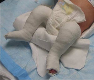 The third cast - The Achilles tendon is stretched, bringing the outer edge of the foot into a more normal position.