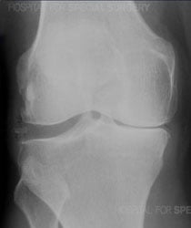 X-ray of an arthritic knee from an article about Athritis of the Knee from Hospital for Special Surgery