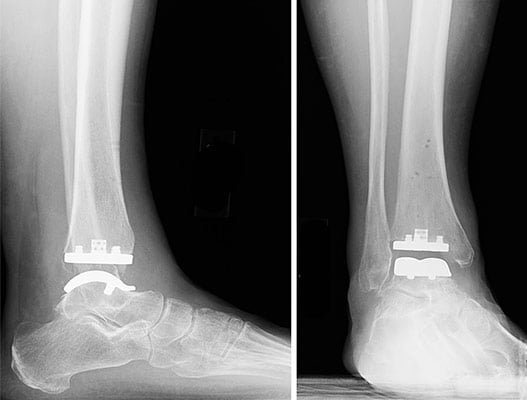 X-ray images of a total ankle replacement.