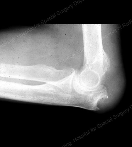 X-ray of gouty erosion at the proximal ulna at the elbow