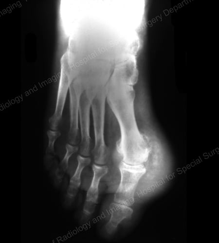 X-ray of gouty change and soft tissue calcification about the base of the 1st toe