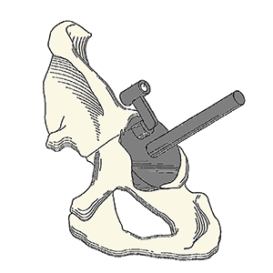 Acetabular Positioning System