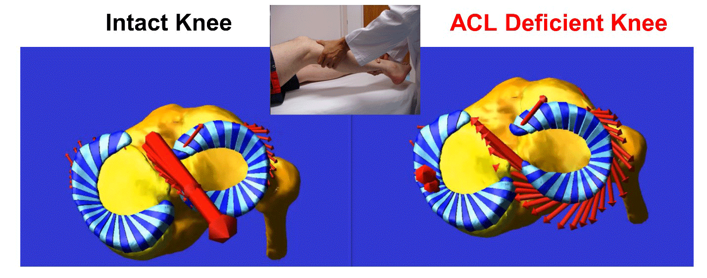 ACL Deficient