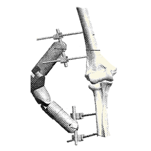 External Fixation Device