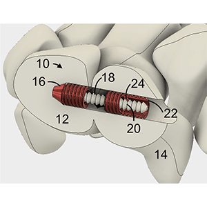 Interosseous Coupler