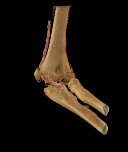 3D visualization of bone (beige) and entrapped medium nerve (red) at the epicondylar fracture site of the elbow