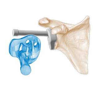 Patient Specific Shoulder Arthroplasty Guides