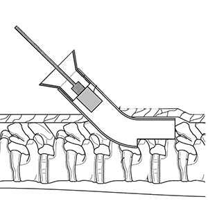 Percutaneous Graft Delivery System