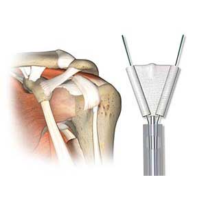 Rotator Cuff Patch Repair