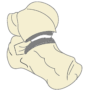 Subtalar Joint Arthroplasty System
