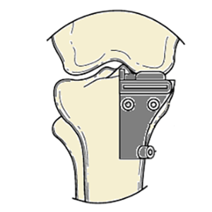 Unicompartmental Tibial Cutting Guide