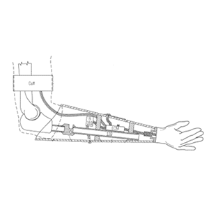 Upper Extremity Prosthesis