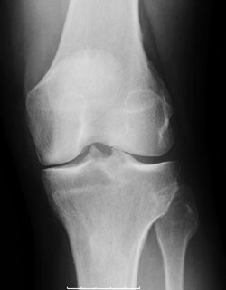 Radiografie van artrose van het mediale compartiment voorafgaand aan een gedeeltelijke knieprothese