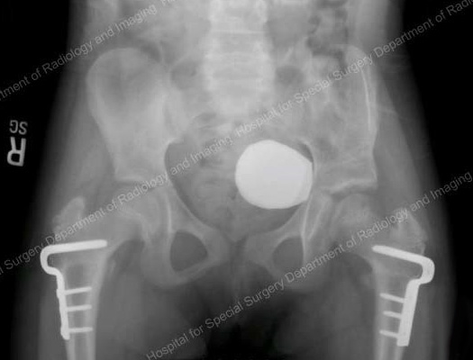 Post-operative X-ray of left pelvic osteotomy and bilateral VRO demonstrating that both hips are located.