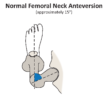 femoral anteversion neck normal hip osteotomy version left overview joint figure hss edu