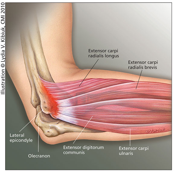 Traditional, Conservative Treatments for Tennis Elbow | HSS