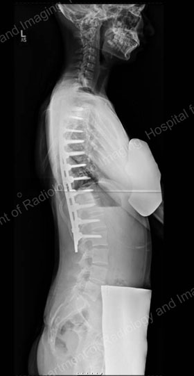 Adolescent Idiopathic Scoliosis: An Overview