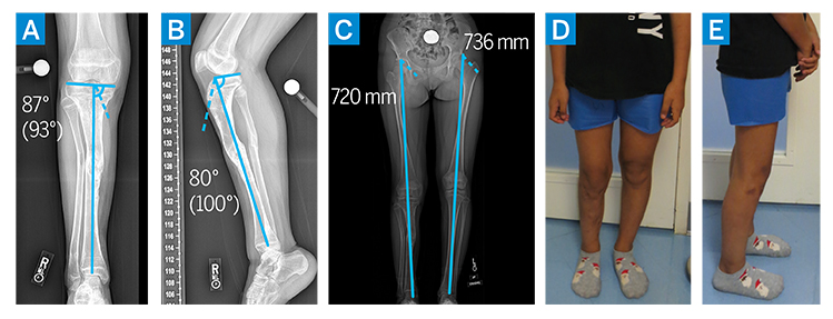 Tibia Lengthening and Deformity Correction With a Multiplanar External  Fixator
