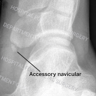 Accessory Navicular Syndrome  Foot & Ankle Specialty Group