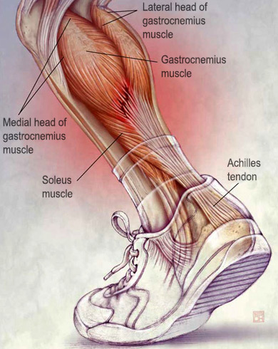 How to treat antibiotics induced Achilles tendonitis