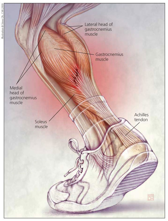 calcaneal tendon pain treatment