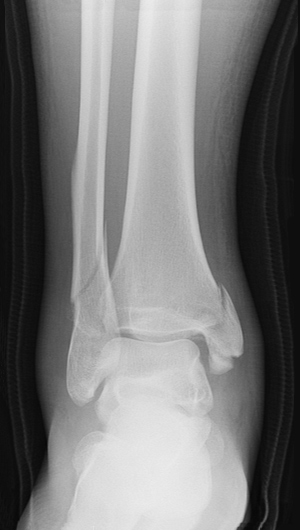 Broken Ankle: Types of Fractures, Diagnosis & Treatments