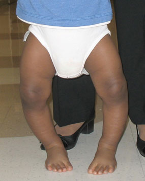 Bowed Legs - Kids Plus Pediatrics