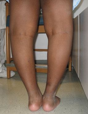 disease blount growth child bowlegs leg guided bowleg deformity prior due bow figures treatment front