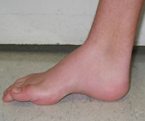 Cavovarus foot - medial to lateral view of a right cavovarus foot - Note the Pathognomonic High Arch from an article about Pediatric Foot Deformities.