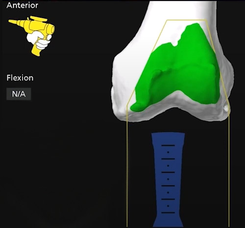 Screenshot from the InLine Orthopaedics navigation system