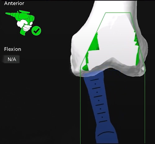Navigation image of the femoral component planning. The size of the